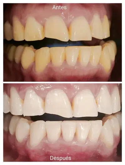 tratamiento blanqueamiento dental antes despues
