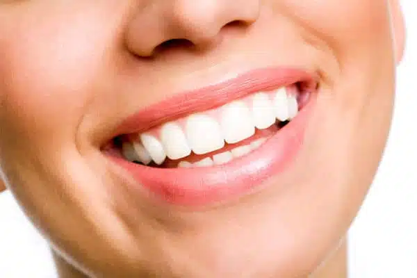 estetica-dental-carillas-dentales