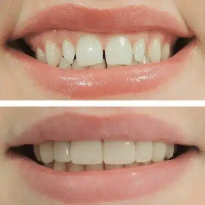 antes despues carilla dental