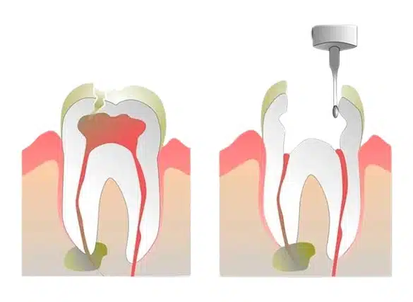 caries dental precios barcelona