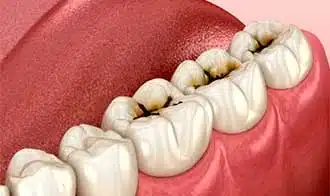 Caries dental