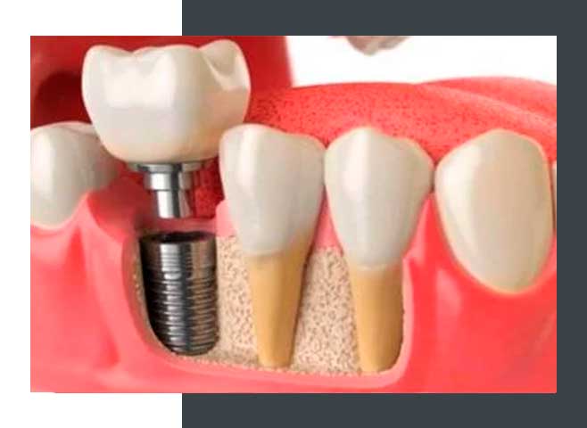 tratamiento-implante-dental