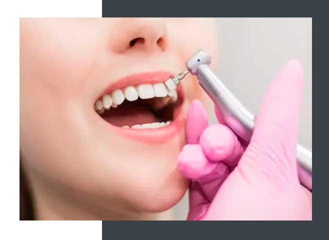 tratamiento-limpieza-dental