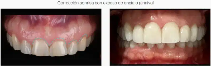 sonrisa gingival solucion