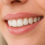 Resultado estetico con corona dental Instituto Volpe