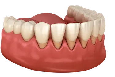 Tratamiento-periodontal-para-detener-la-retraccion-de-encias-y-evitar-la-perdida-dental