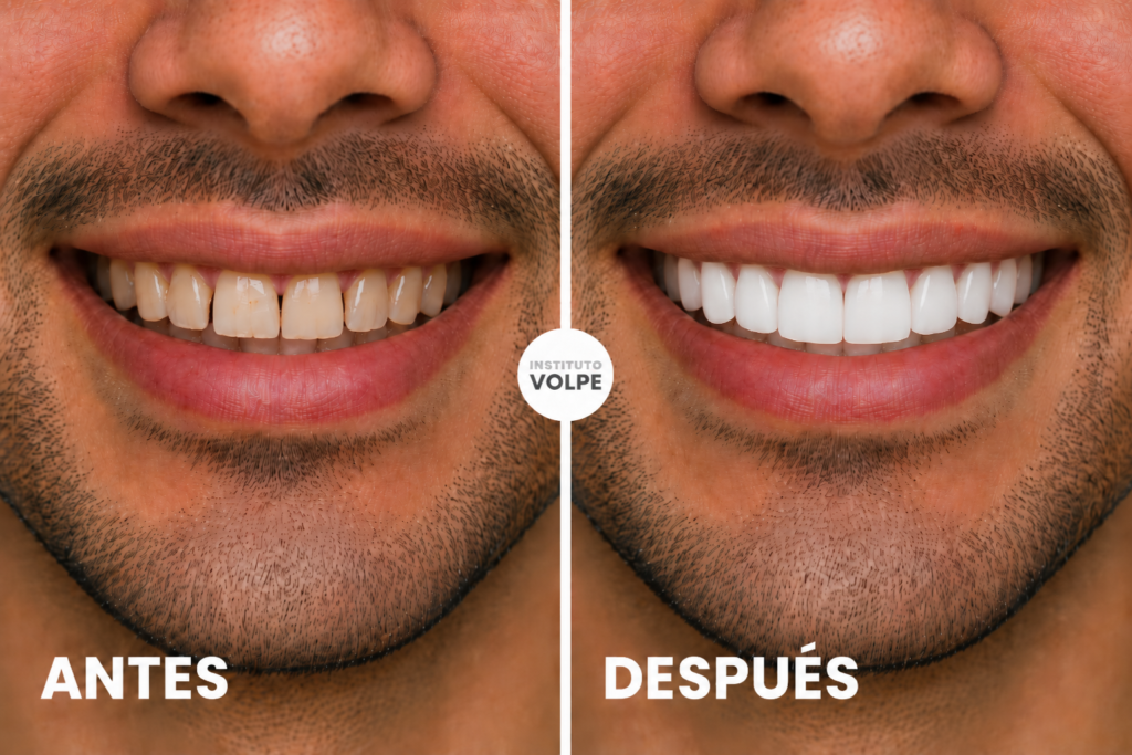 carillas-de-composite-chico-con-27-años-dientes-con-diastemas-y-oscurecidos