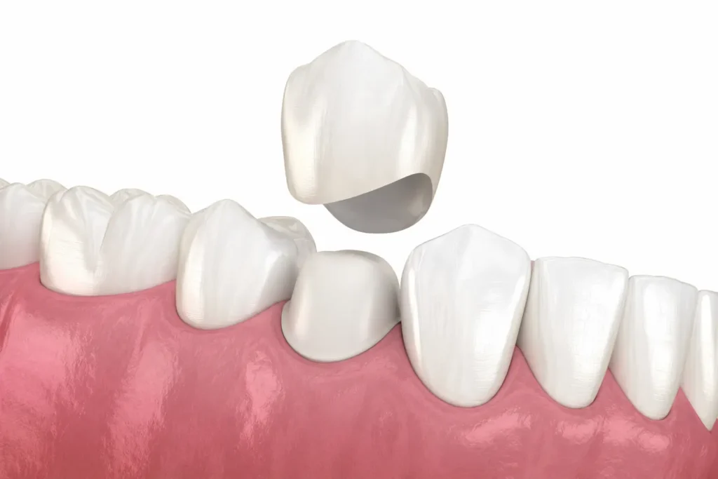 corona dental