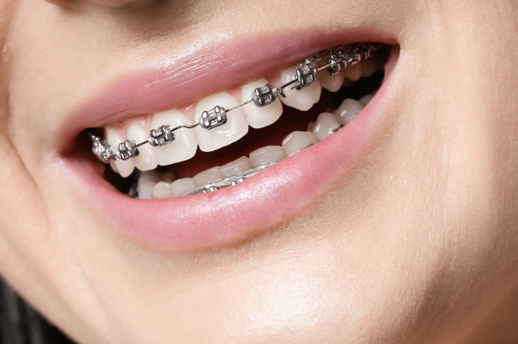 ortodoncia-tradicional-9 ortodoncia-tradicional-9