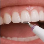resultado de limpieza dental Flash Pearl Instituto Volpe.webp