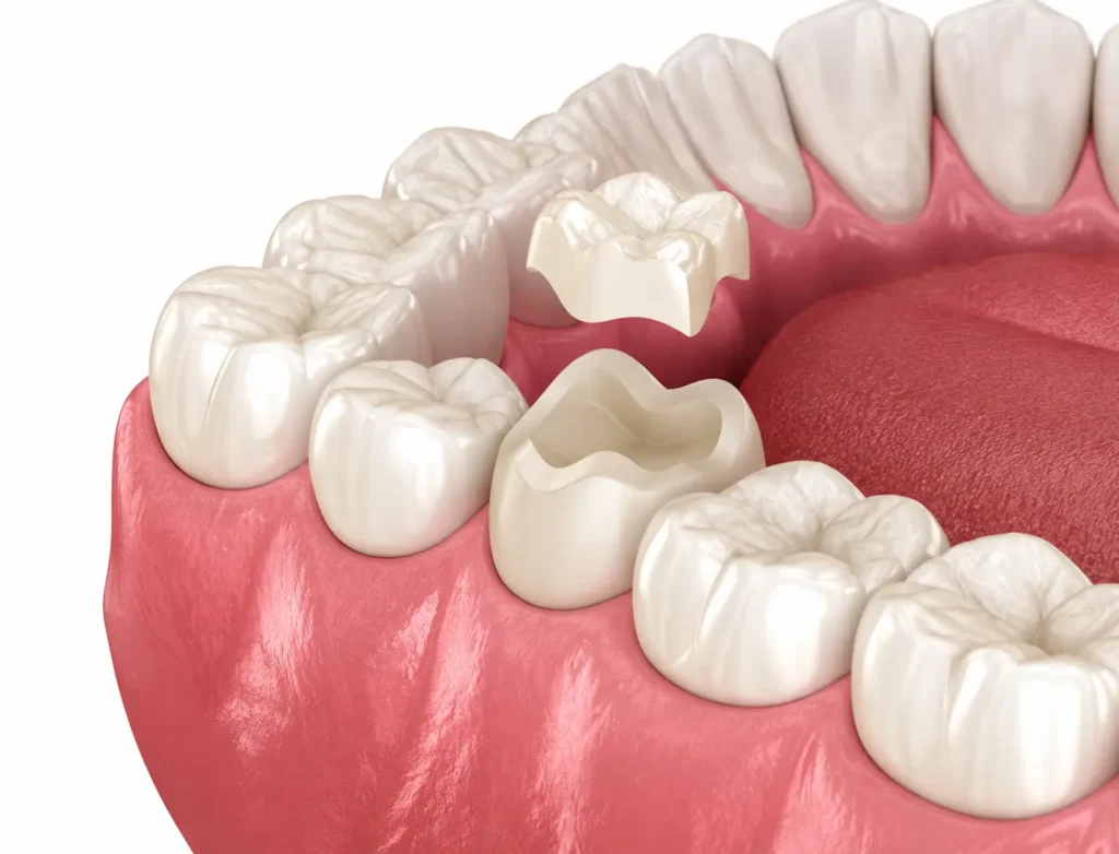 incrustación dental