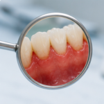 periodontitis