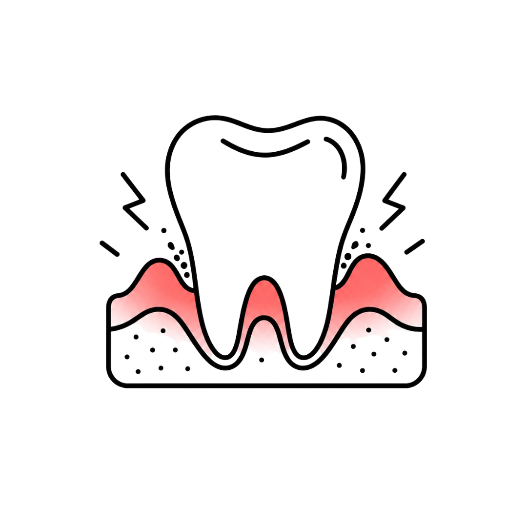 periodontitis
