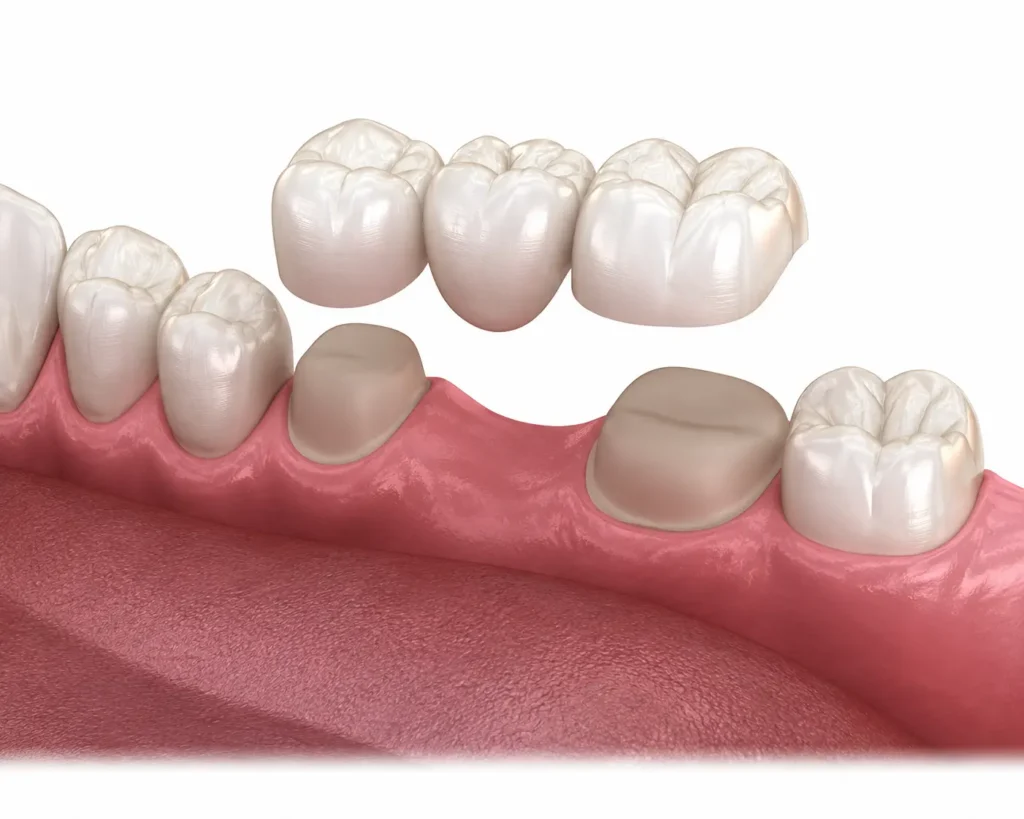 puente dental fijo