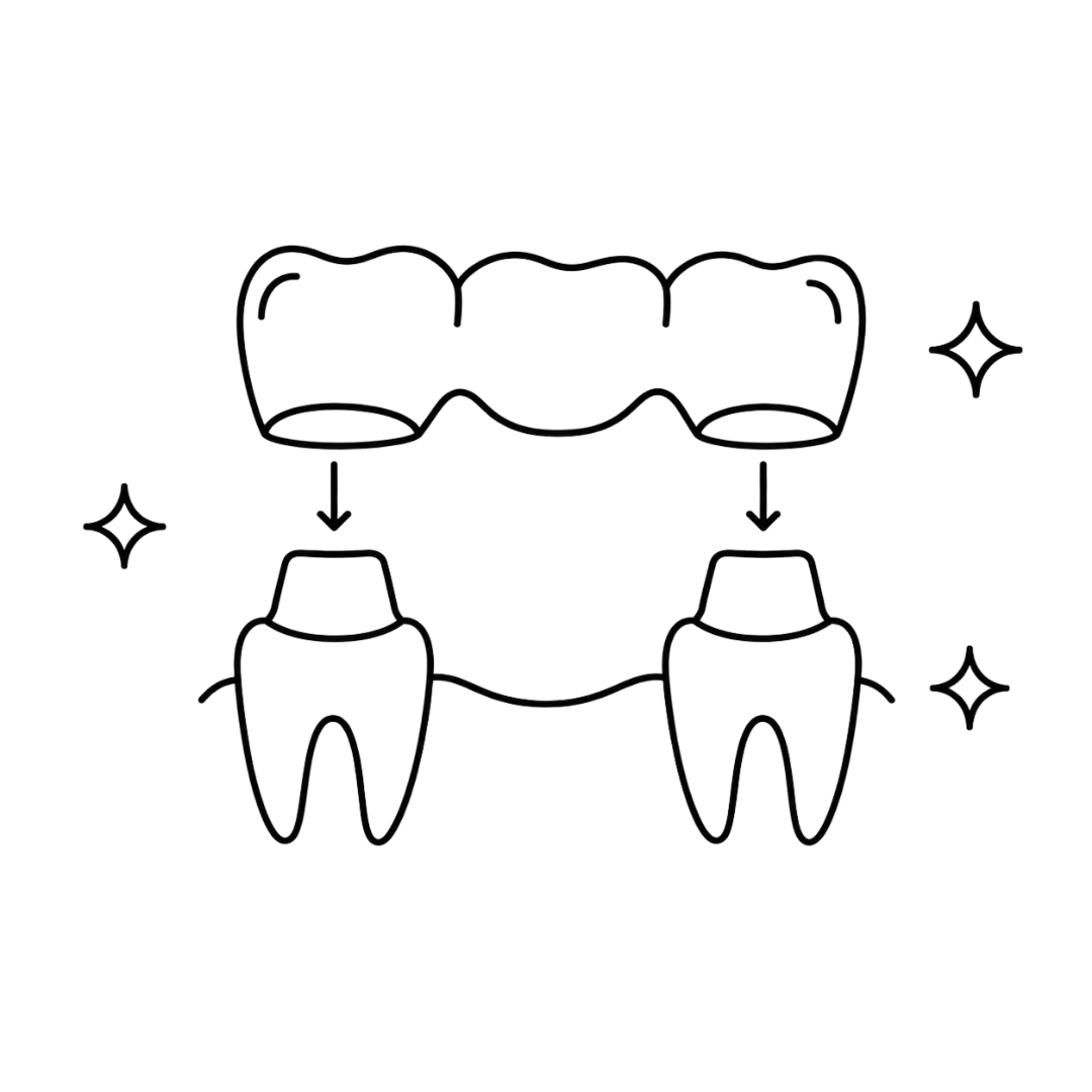 puentes dentales